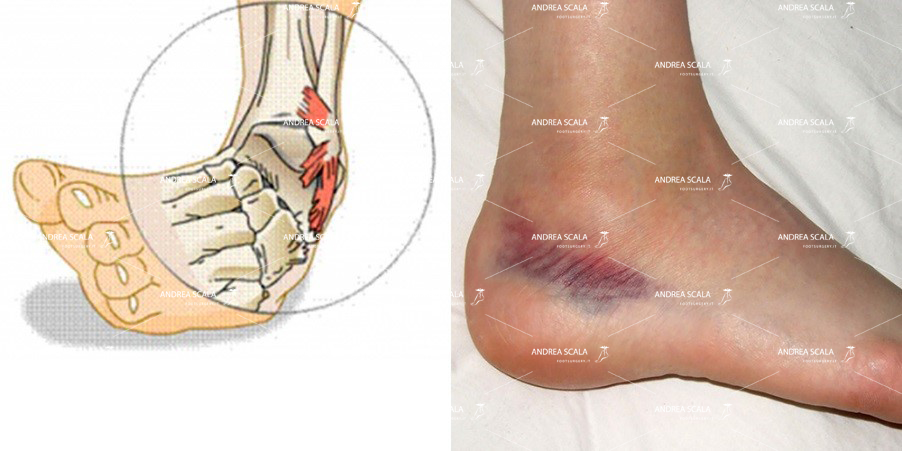 Immagine distorsione caviglia